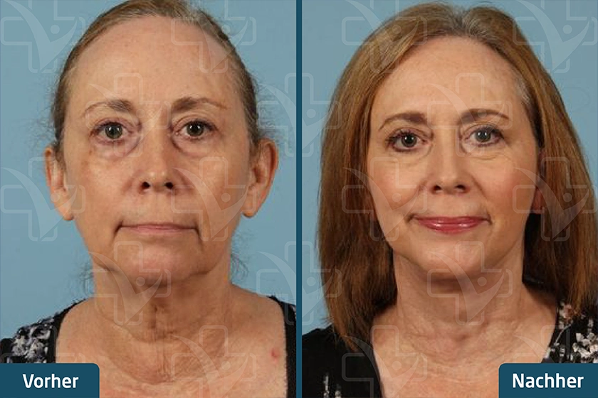Gesichtsstraffung Face Lift Türkei Vorher Nachher