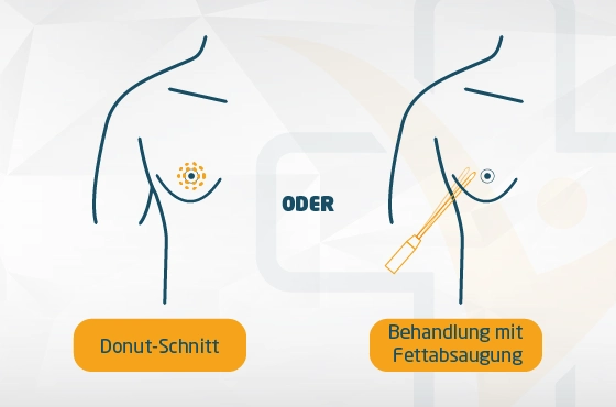 Gynäkomastie – Schnittführung und Methoden
