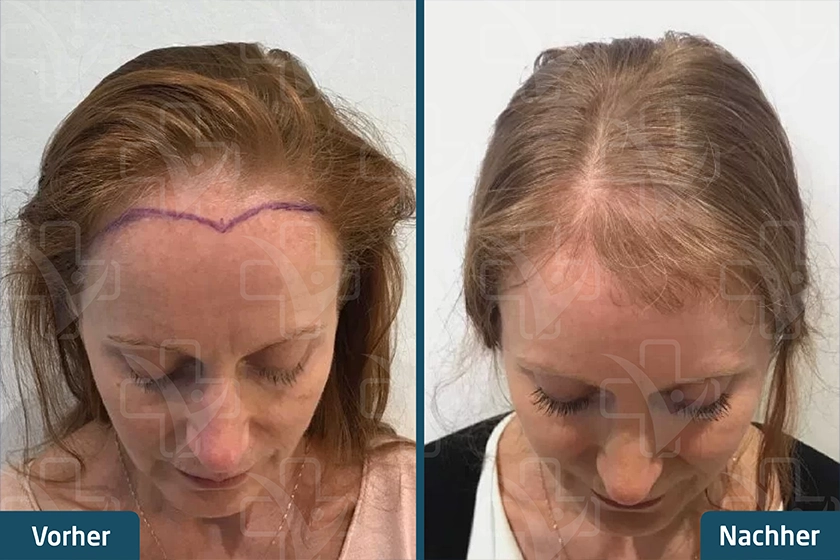 Haartransplantation bei Frauen Türkei Vorher Nachher