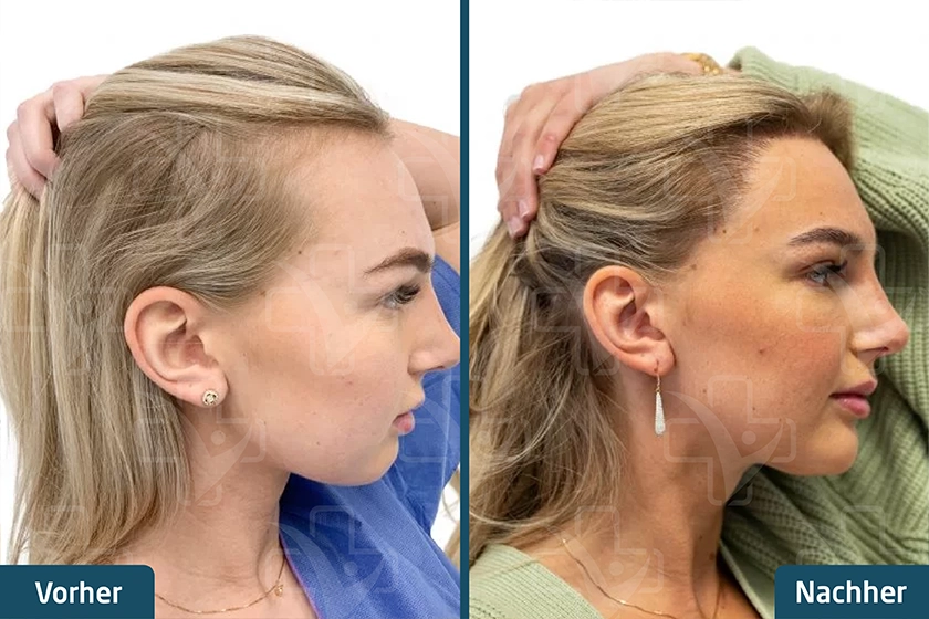 Haartransplantation bei Frauen Türkei Vorher Nachher