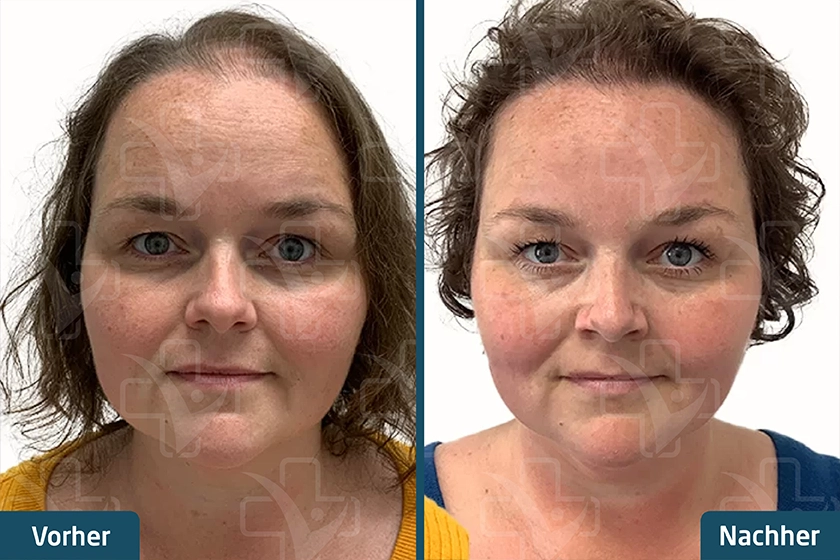 Haartransplantation bei Frauen Türkei Vorher Nachher