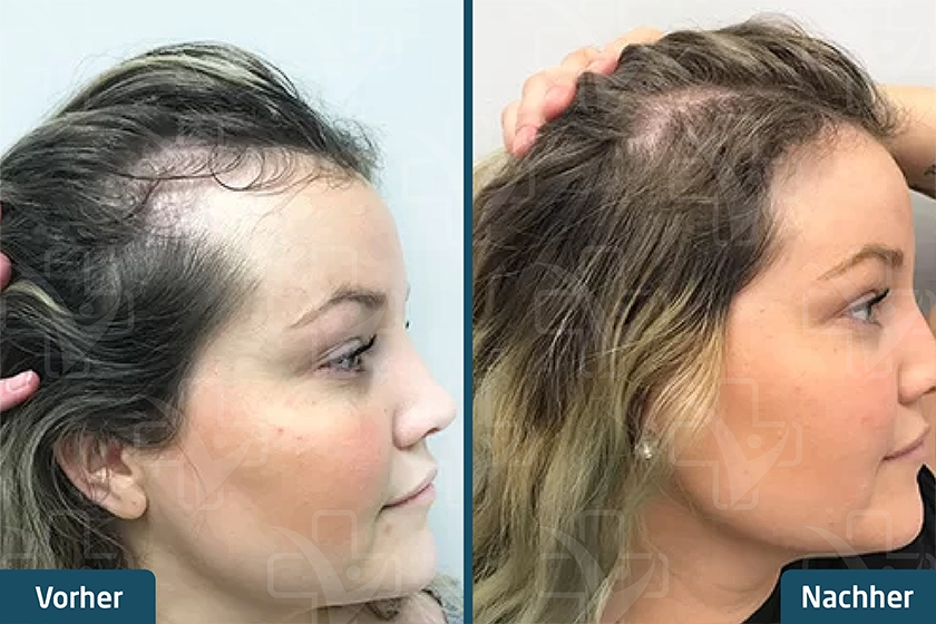 Haartransplantation bei Frauen Türkei Vorher Nachher