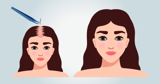Haartransplantation bei Frauen Türkei