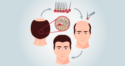 Haartransplantation bei „Med Center Türkiye“ in der Türkei in Antalya Türkei.