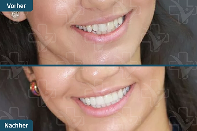 Hollywood Smile Türkei Vorher Nachher