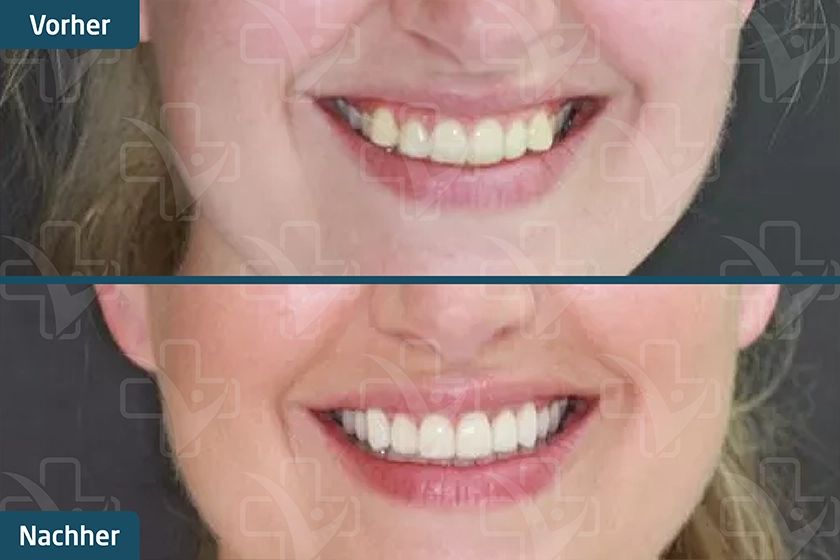 Hollywood Smile Türkei Vorher Nachher