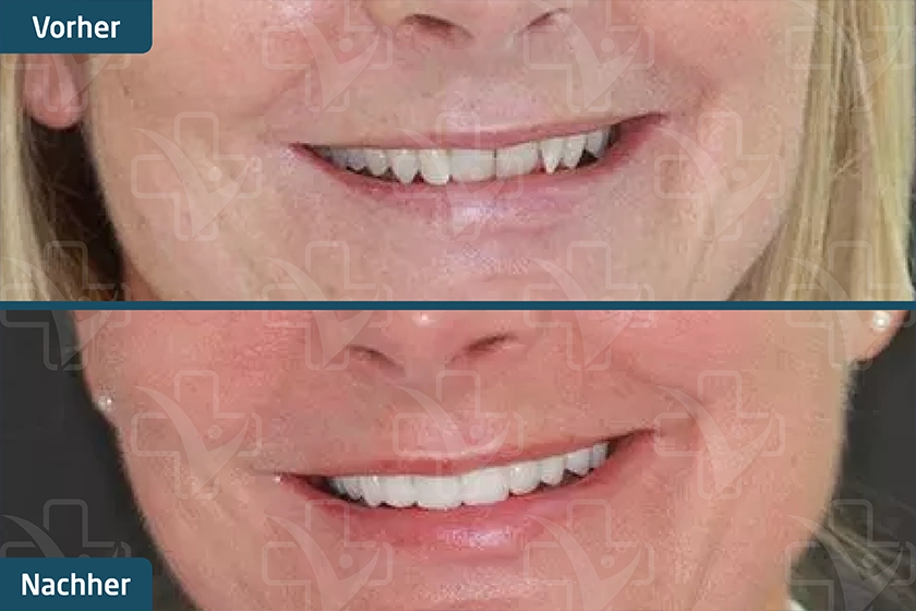 Hollywood Smile Türkei Vorher Nachher