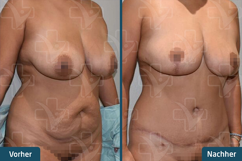Mummy Makeover Türkei Vorher Nachher