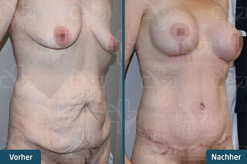 Mummy Makeover Türkei Vorher Nachher