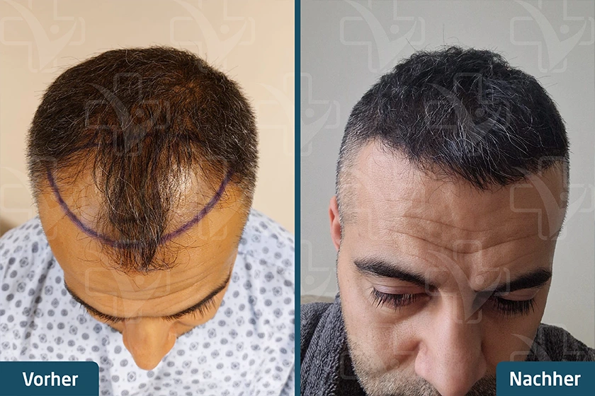 Saphir FUE Haartransplantation Türkei Vorher Nachher