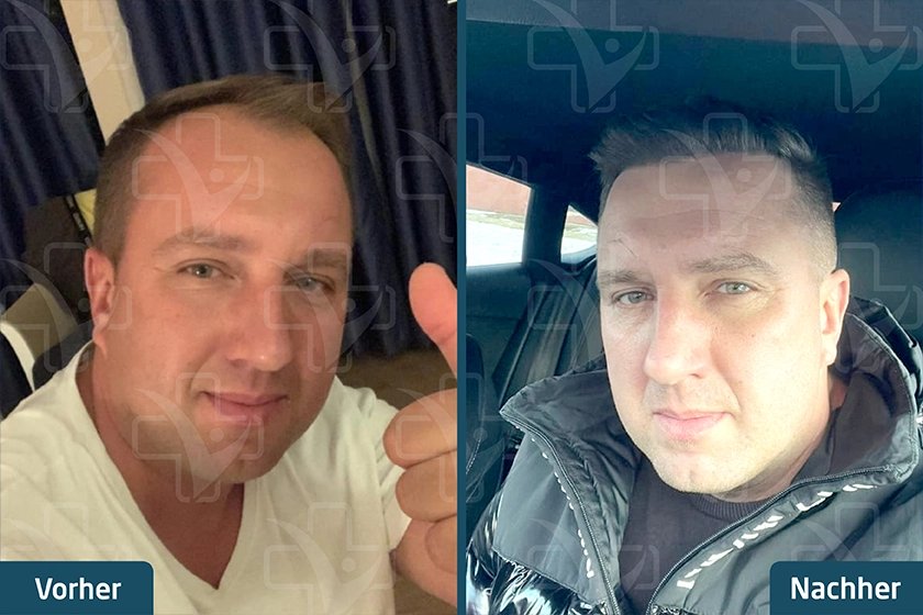 Saphir FUE Haartransplantation Türkei Vorher Nachher