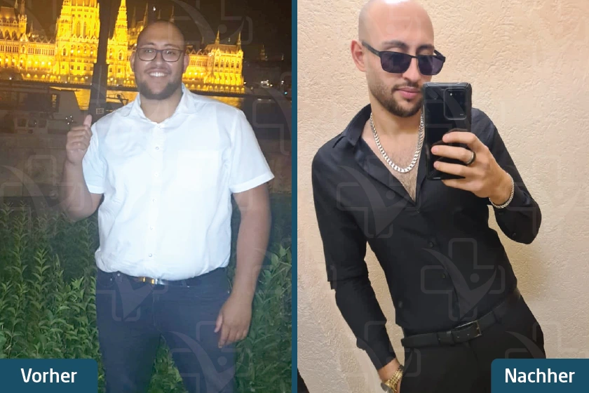 Schlauchmagen Türkei Vorher Nachher