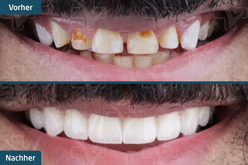 Zahn-Veneers Türkei Vorher Nachher