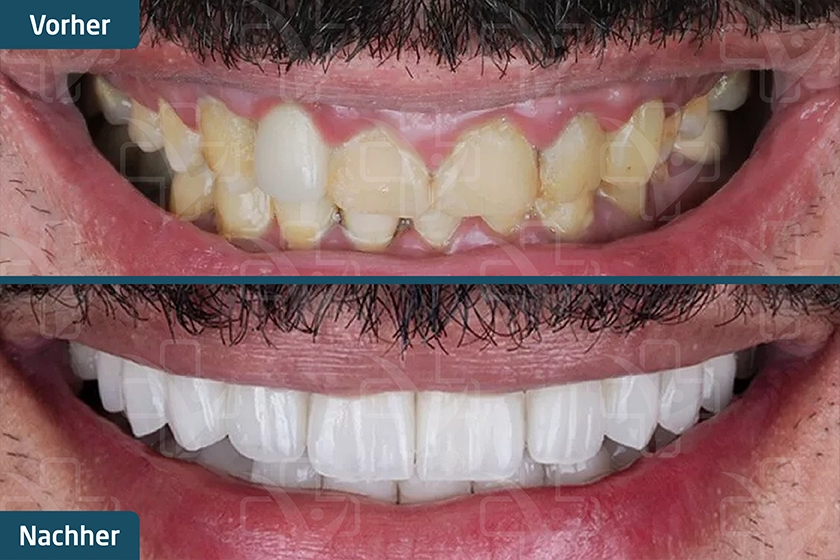 Zahn-Veneers Türkei Vorher Nachher
