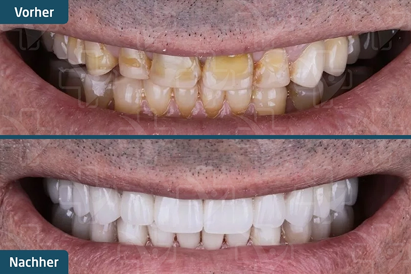Zahn-Veneers Türkei Vorher Nachher
