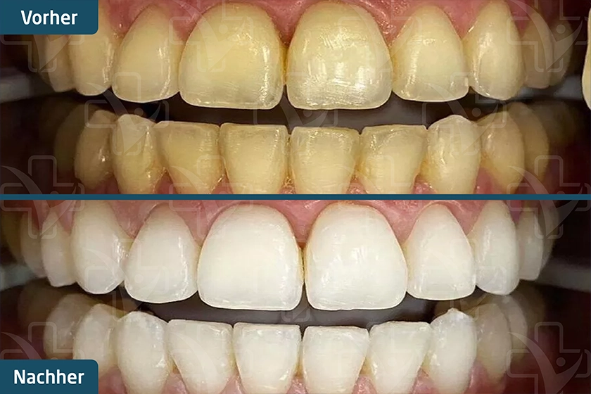 Zoom Bleaching Türkei Vorher Nachher