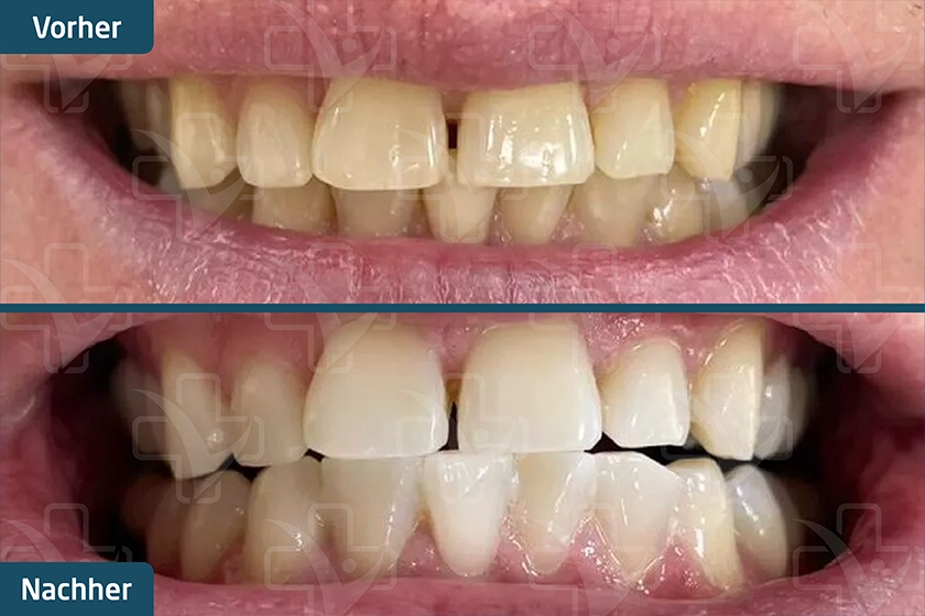 Zoom Bleaching Türkei Vorher Nachher