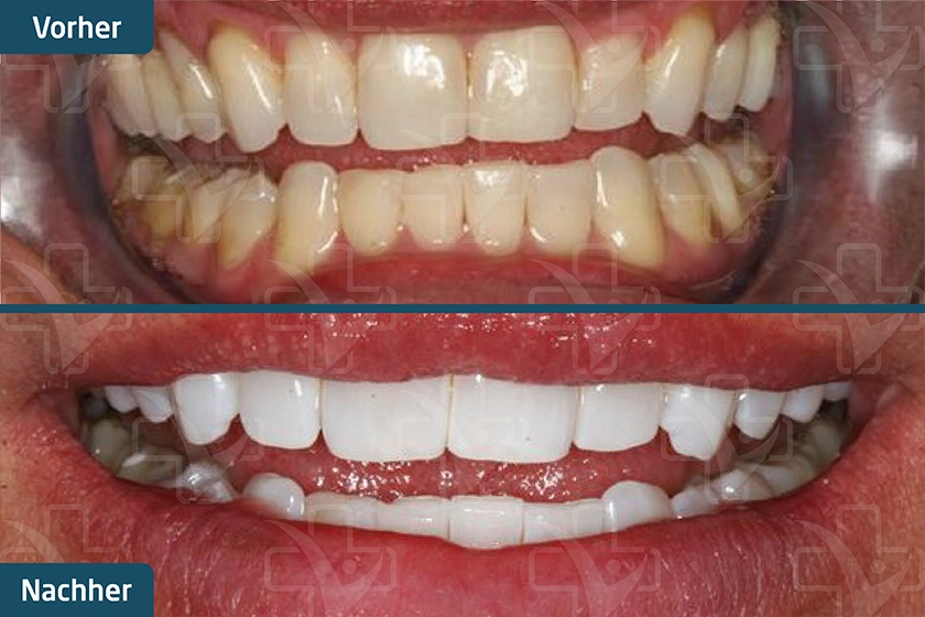 Zoom Bleaching Türkei Vorher Nachher