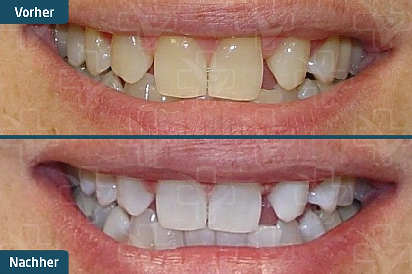 Zoom Bleaching Türkei Vorher Nachher